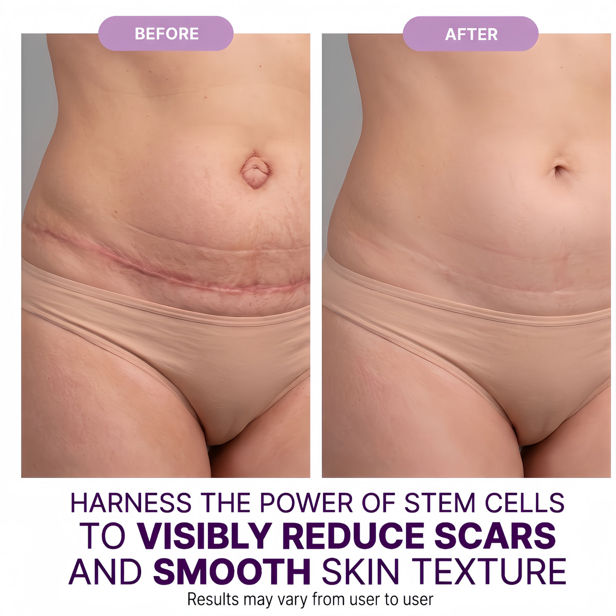 Regenscar Advanced Scar Treatment Tummy Tuck