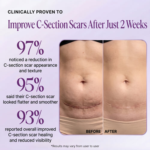 Regenscar Advanced Scar Treatment C-section