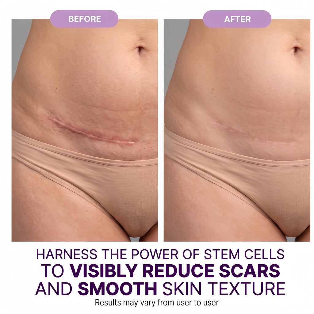 Regenscar Advanced Scar Treatment C-section