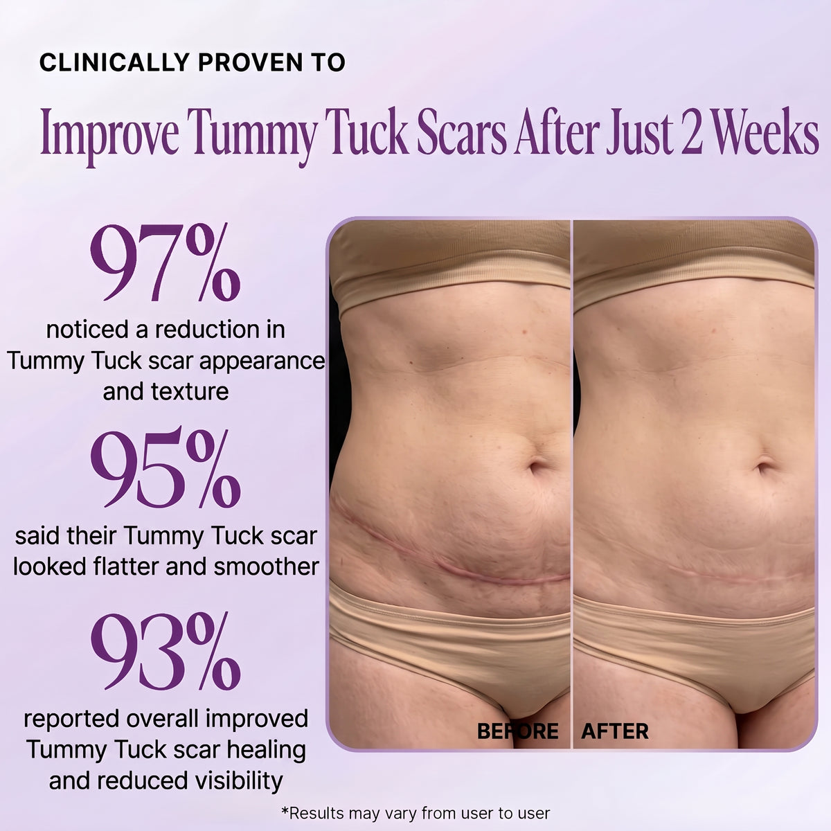 Regenscar Advanced Scar Treatment Tummy Tuck