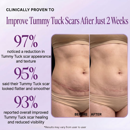 Regenscar Advanced Scar Treatment Tummy Tuck