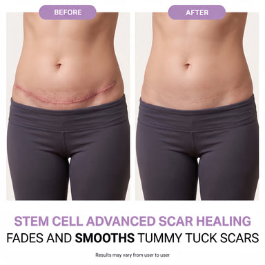 Regenscar Advanced Scar Treatment Tummy Tuck
