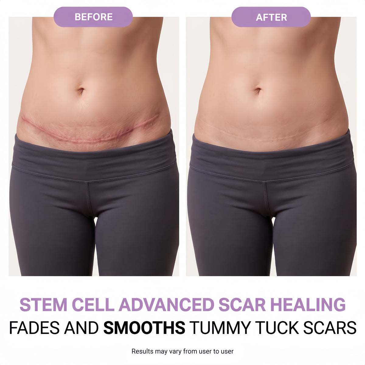 Regenscar Advanced Scar Treatment Tummy Tuck