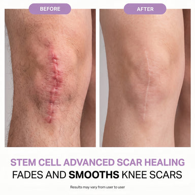 Regenscar Advanced Scar Treatment Knee Scars
