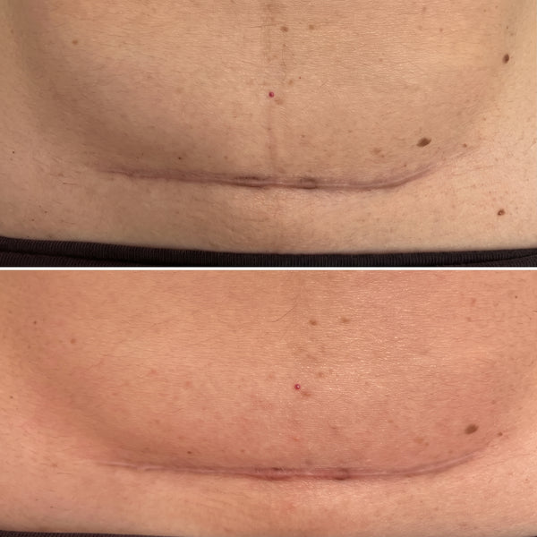 Works on old scar too!