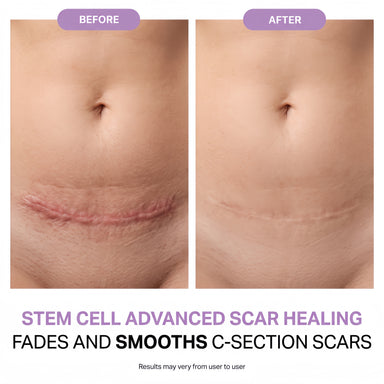 Regenscar Advanced Scar Treatment