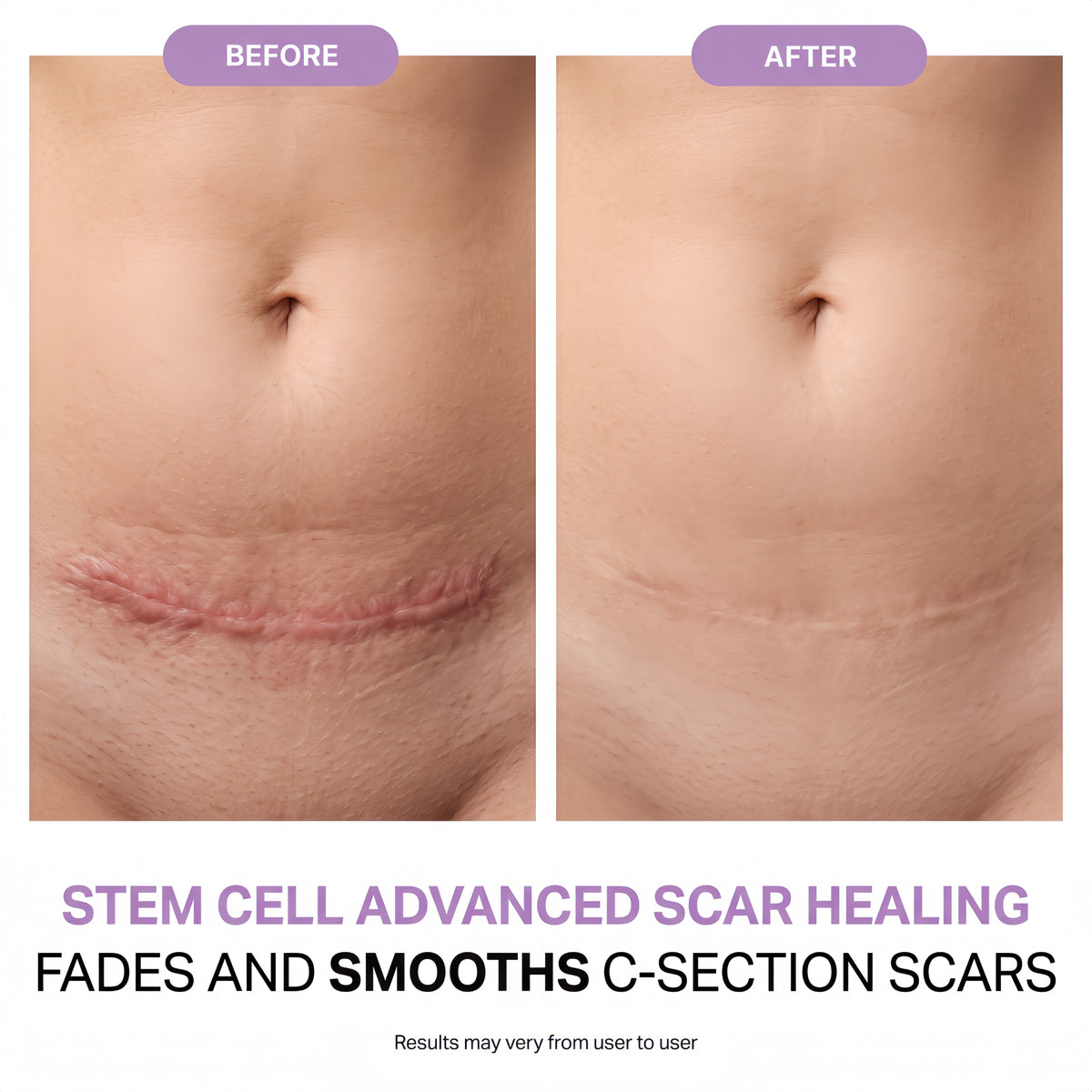 Regenscar Advanced Scar Treatment