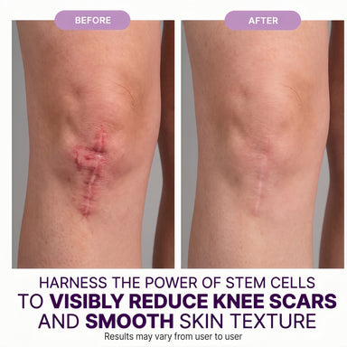 Regenscar Advanced Scar Treatment Knee Scars