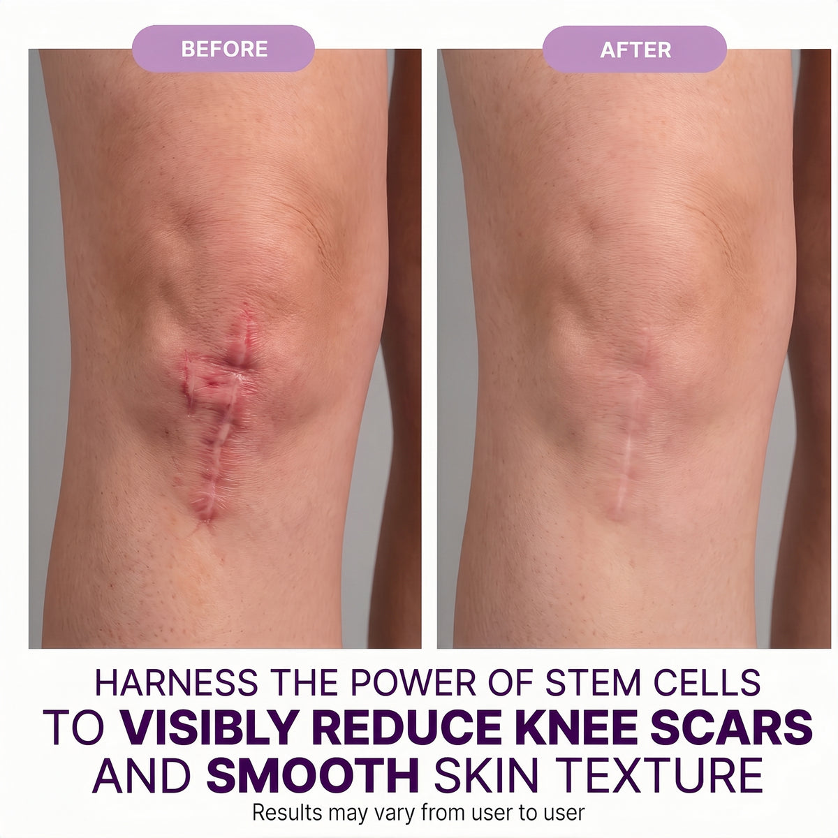 Regenscar Advanced Scar Treatment Knee Scars