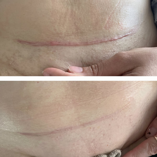 Lost 83 lbs and started using this gel for scar