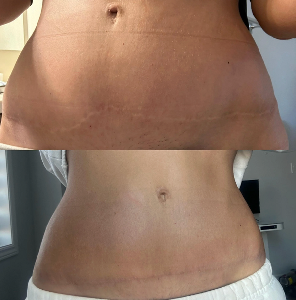 Great for Tummy Tuck