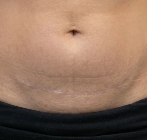 5.) Gentle Enough for Sensitive Post-Op Skin