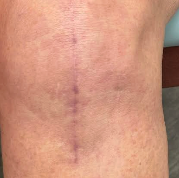 My PT told me to massage my scar. This is what I use